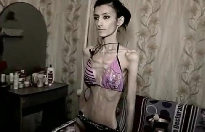 Zastrašujuće posljedice anoreksije