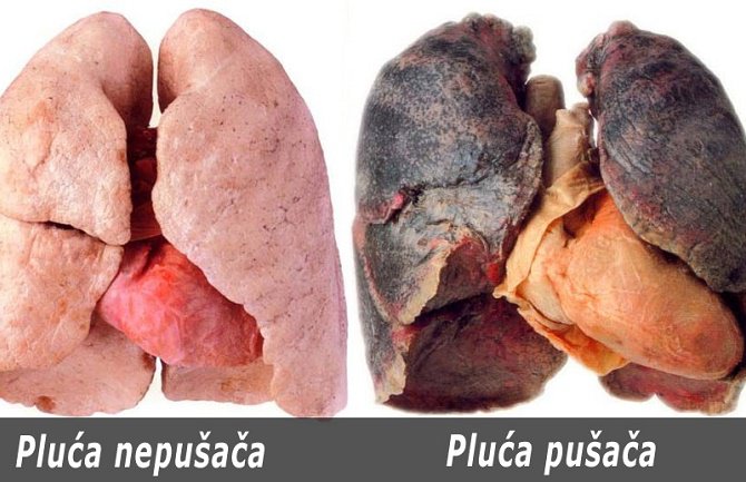 Kako očistiti pluća nakon prestanka pušenja 