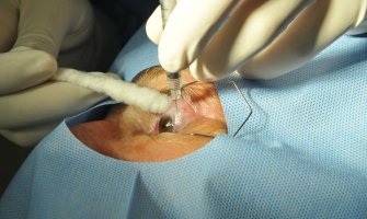 Na operaciju katarakte čeka više od hiljadu pacijenata