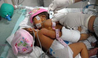 Dvije djevojčice dijele jedno srce