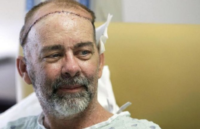 Uspješna  prva transplantacija lobanje