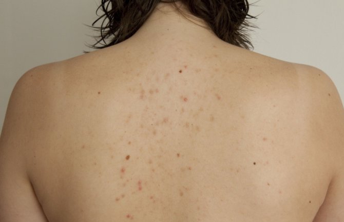 Izbacite ove namirnice i preparate ako želite da pobijedite bubuljice na leđima