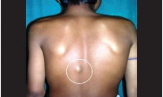 Narodni lijek koji otklanja masno tkivo