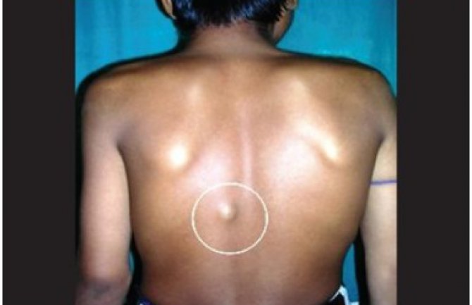 Narodni lijek koji otklanja masno tkivo