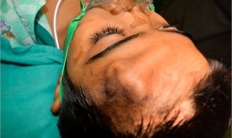 Dječak(12) dobio nos na čelu!