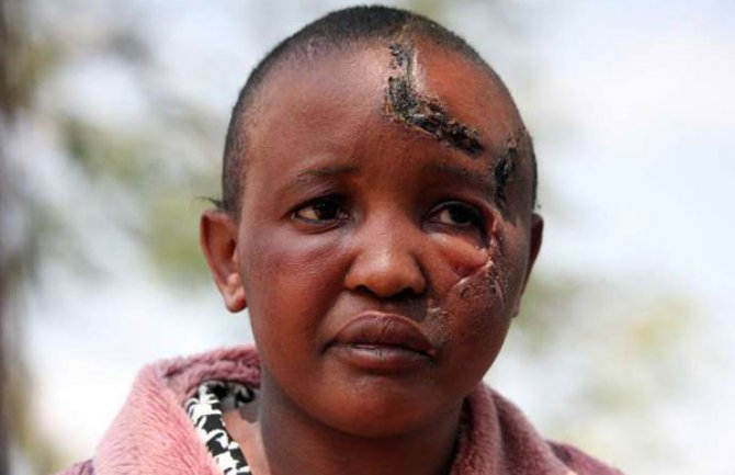 Ženi odsjekao obje ruke jer ne mogu da imaju djecu