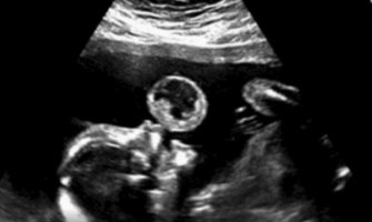 Na ultrazvuku vidjeli bebu koja 