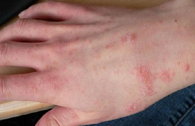 Od 424 oboljele osobe, svaka četvrta imala šugu