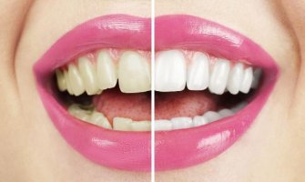 Evo kako da izbijelite zube na prirodan način