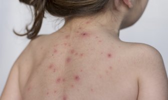 Djevojčica zaražena morbilama puštena kući