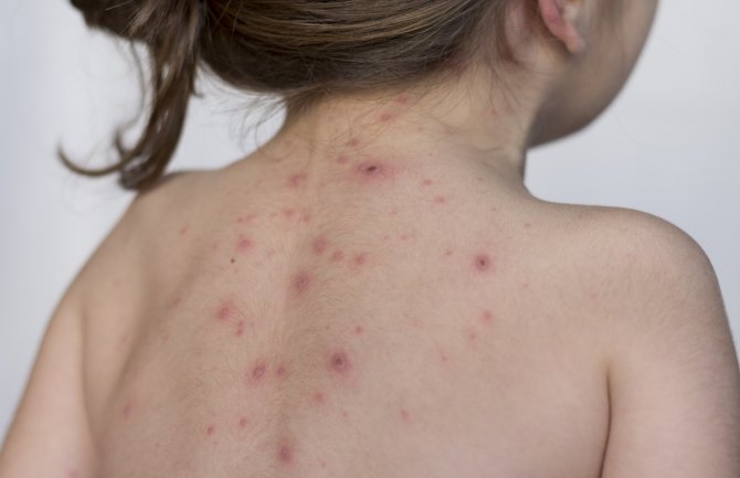 Djevojčica zaražena morbilama puštena kući