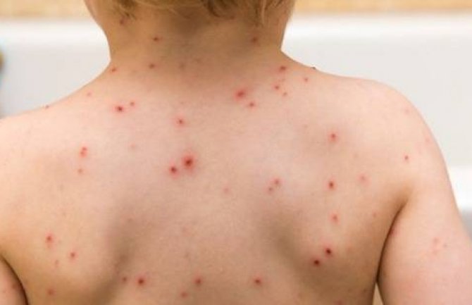 Oboljeli od malih boginja na kućnom liječenju