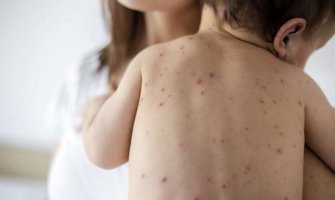 Od malih boginja od početka godine oboljelo 14 osoba