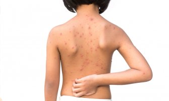 Od početka godine registrovano 29 oboljelih od morbila