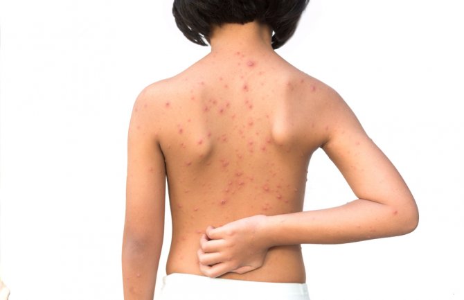 Od početka godine registrovano 29 oboljelih od morbila