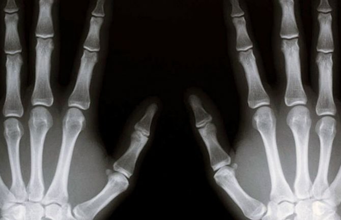 Izuzetno rijetko oboljenje: Nestale kosti pacijentkinje (FOTO)