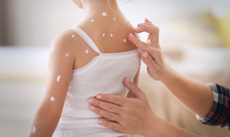 Od početka godine od malih boginja oboljelo 160 osoba