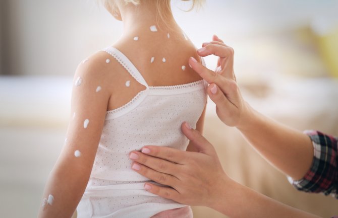 Od početka godine od malih boginja oboljelo 160 osoba