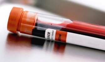 Razvijen krvni test za otkrivanje melanoma u ranoj fazi