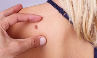 Od karcinoma kože godišnje oboli 300 građana