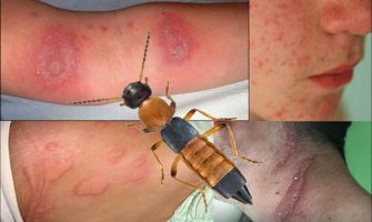 Virpazar: Više osoba zatražilo pomoć zbog opekotina  zadobijenih od bube pederus