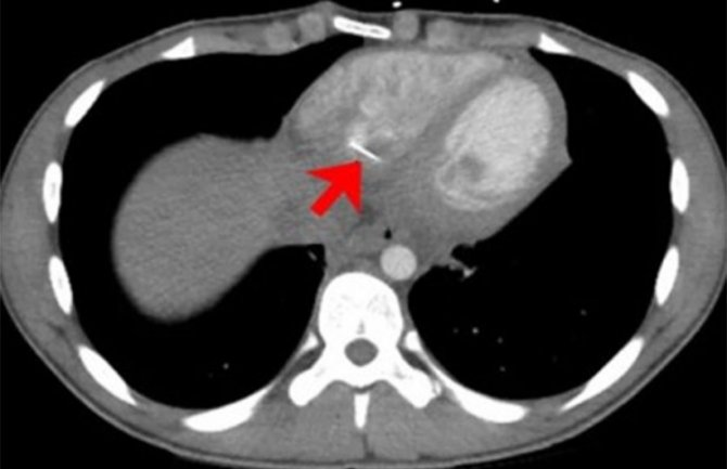 Tinejdžer progutao iglu za šivenje, doktori je pronašli u srcu